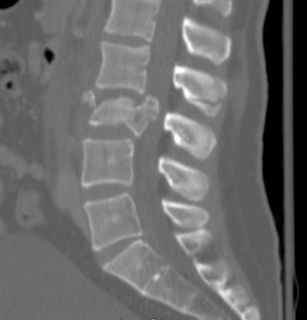 Chance Fracture (flexion-distraction injury) - Spine - Orthobullets